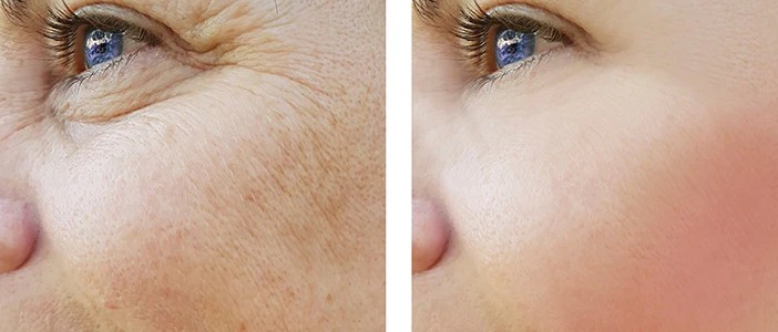 Skin Rejuvenation & Treatment